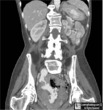 Small Bowel Lymphoma